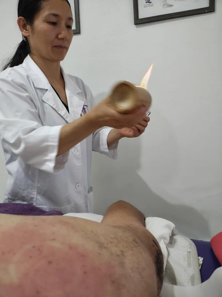 Docente aplicando ventosa de fuego con un algodón encendido sobre la espalda de un paciente.